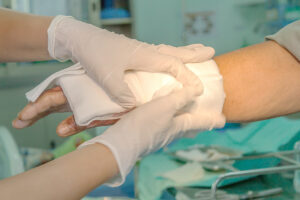 Why You Should Choose Roach Law Car Accident Lawyers To Handle Your Burn Injury Claim in St. Louis, MO