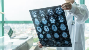 How Roach Law Car Accident Lawyers Can Help After a Brain Injury in Chesterfield, MO